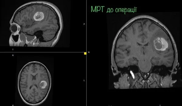 Під час операції розбудили пацієнтку: нейрохірург з Луцька видалив пухлину 16-річній дівчині (фото)