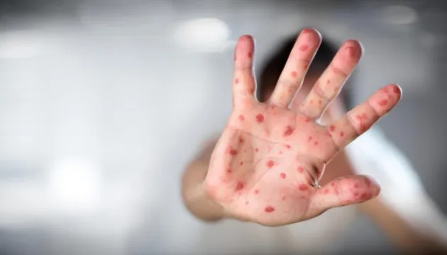 У Луцьку захворюваність на кір виросла майже вдесятеро