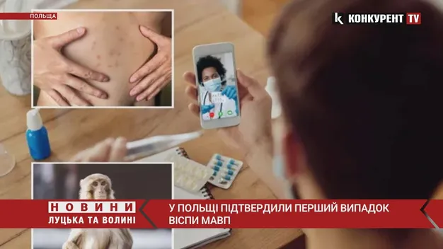 У Польщі підтвердили перший випадок мавпячої віспи (відео)