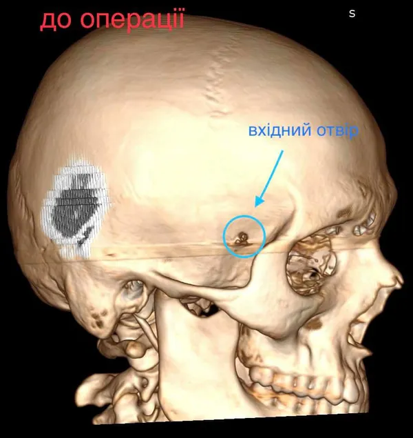 У Волинській обласній дитячій лікарні з мозку підлітка виймали кулю (фото, відео)
