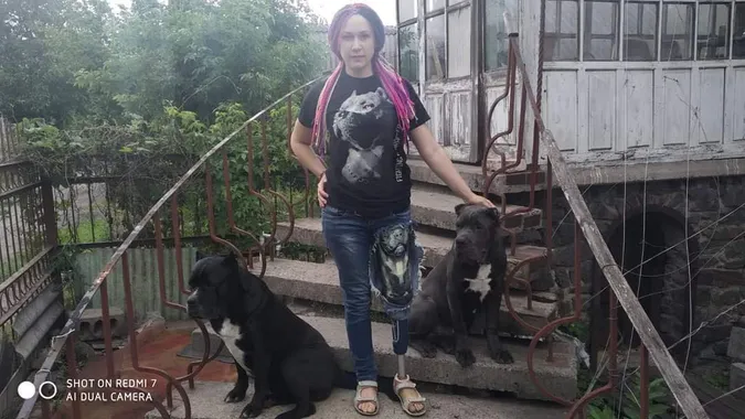 «Я – на протезі, дитина – у гіпсах»: маріупольчанка розповіла, як рятувалася від війни