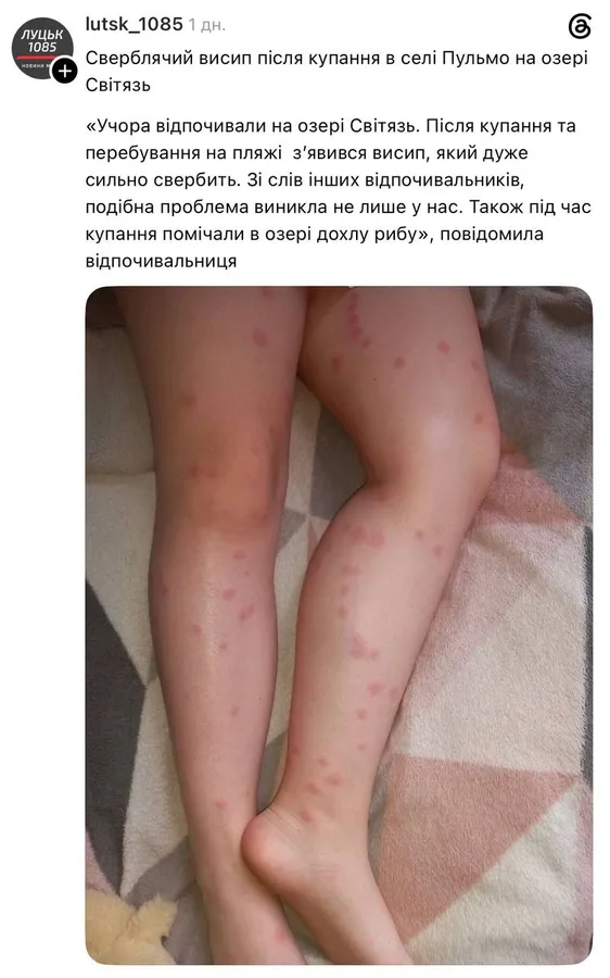 «Свербіж плавця» на Світязі: у мережі масово скаржаться на дивний висип після купання
