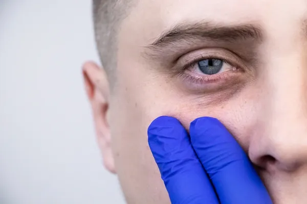 Чому з’являються «мішки» під очима та як їх прибрати