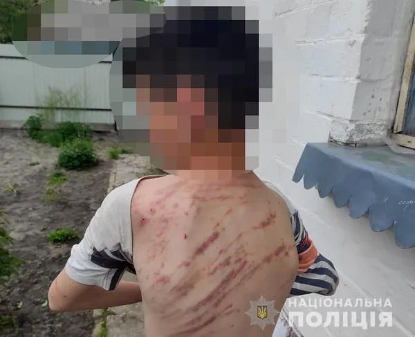 На Волині батьки побили підлітка у «виховних» цілях (фото)