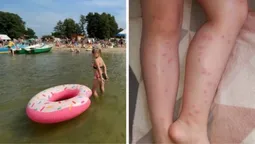 «Свербіж плавця» на Світязі: у мережі масово скаржаться на дивний висип після купання