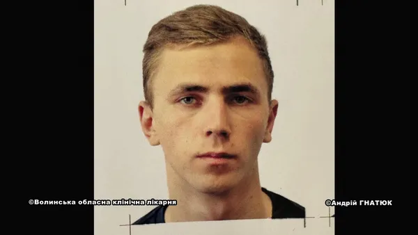 Понівечені війною: як у волинській лікарні допомагають повертати обличчя пораненим воїнам