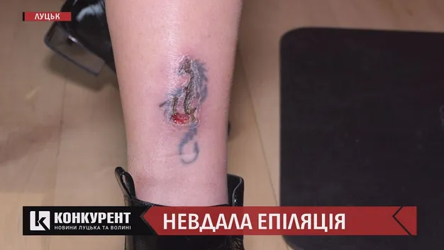 Лазерна епіляція у луцькому салоні завершилася опіком: що кажуть лікарі (відео)