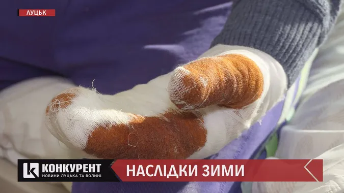 “Пийнув і пішов через ліс вісім кілометрів”: волинянин ледь не втратив руки через обмороження (відео)