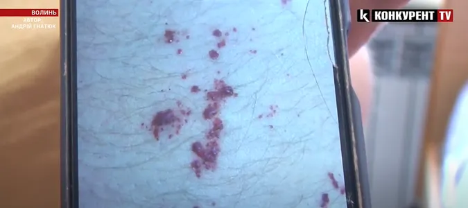 Хвороба Фабрі: на Волині виявили рідкісну і небезпечну хворобу (відео)