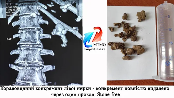 Ковельські лікарі забрали із сечового міхура пацієнта гігантський камінь (фото)