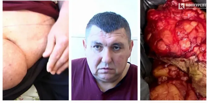 Після операції волинянин полегшав на 25 кг: як так сталося (фото, відео 18+)