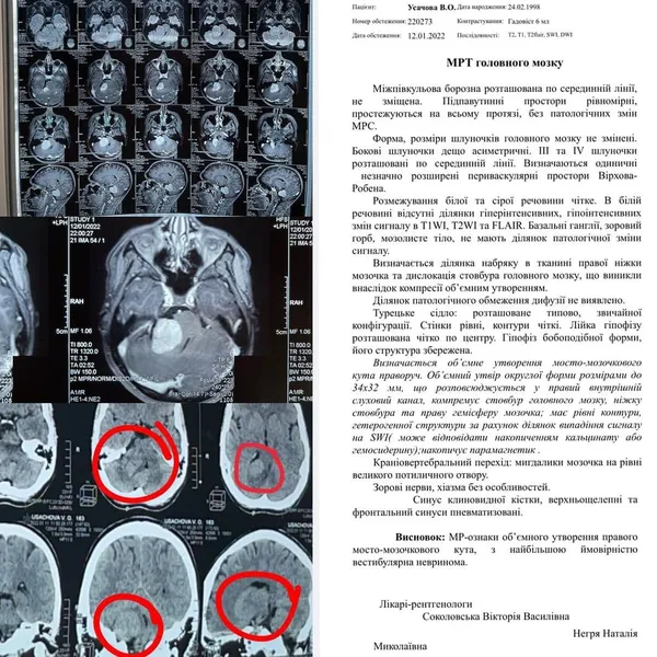 Пухлина мозку: 23-річній лучанці збирають гроші на операцію