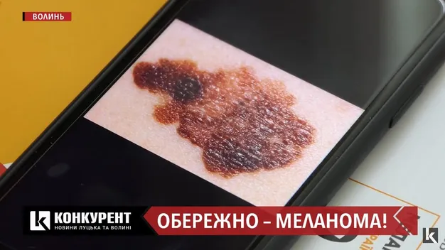 У 90% задавнених випадків люди помирають: як вчасно виявити меланому (відео)
