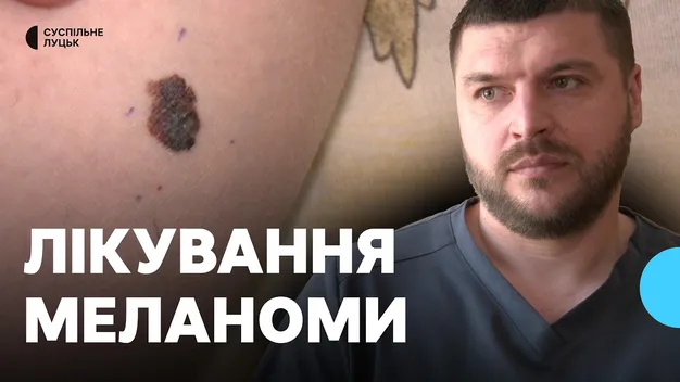 «Не чекати, поки буде пізно»: на Волині 5 людей лікуються від меланоми (відео)