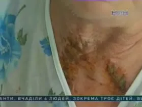 Блискавка вдарила в голову, одяг повністю згорів: як волинянка вижила після розряду в 400 вольтів