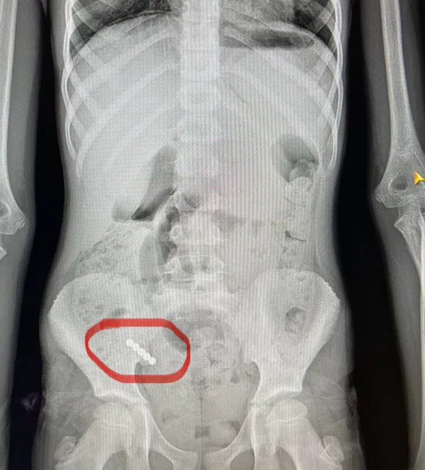 У лікарні в Луцьку оперували дітей, які проковтнули магніти, хрестик, монети та кнопки (фото)