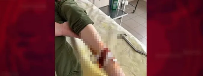 У Нововолинську безпритульний собака покусав 9-річного хлопчика: що каже мер (відео)