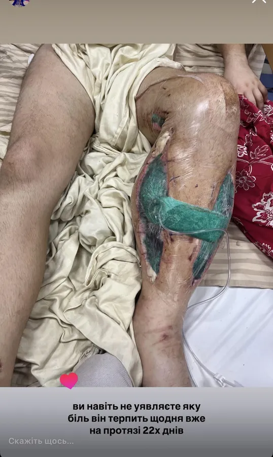 20 операцій без успіху: чоловік блогерки з Луцька втратив чутливість ноги після поранення «на нулі» (фото, відео)