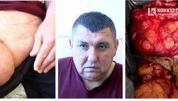 Після операції волинянин полегшав на 25 кг: як так сталося (фото, відео 18+)