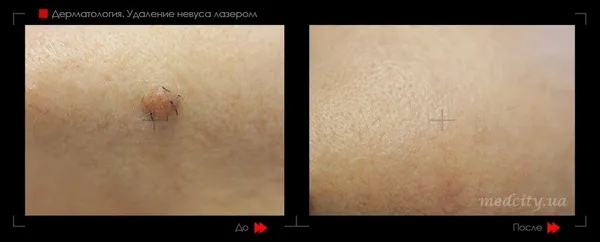 Правило ABCDE для самодіагностики родимок