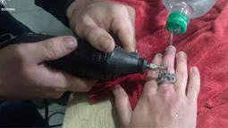 «Ювелірна» робота ДСНС: на Волині рятувальники визволяли палець підлітка