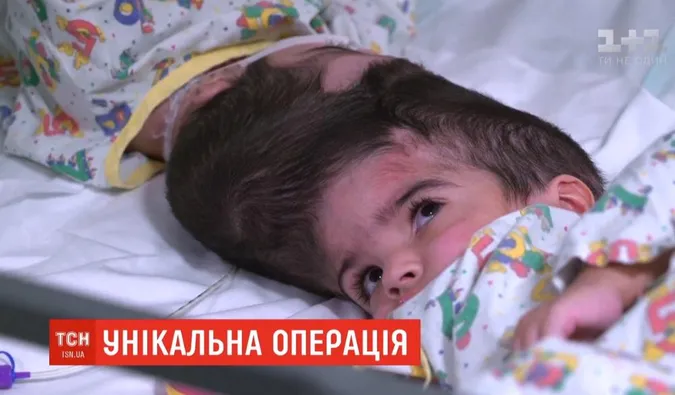 У Британії розділили сіамських близнюків зі злитими черепами (відео)