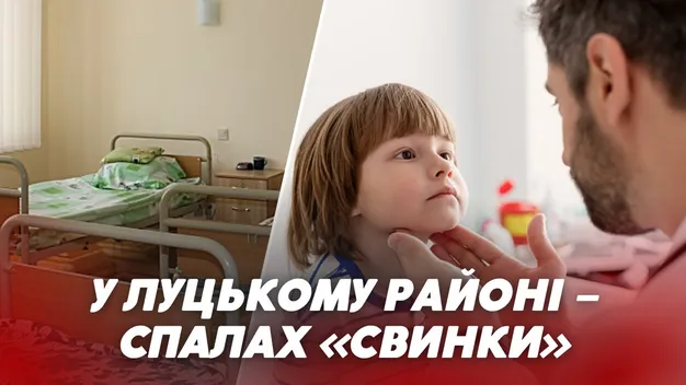 У Луцькому районі виявили спалах свинки: що відомо