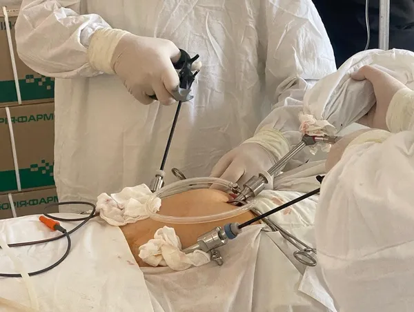 В Нововолинську лікарі вирізали величезну кісту 22-річній дівчині в три проколи (фото)