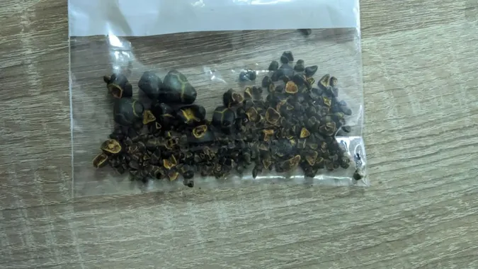 Волинські хірурги вийняли понад 100 каменів з одного пацієнта (фото)