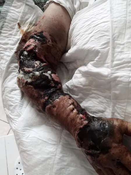 У Ковелі лікарі врятували жінці руку, яку скалічила зернова сівалка (фото 18+)