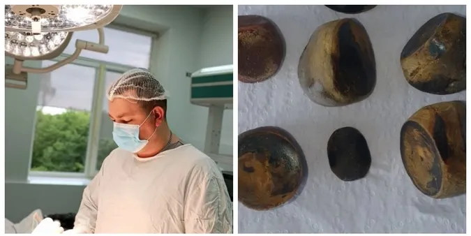 На Волині пацієнту видалили жовчний, вщент забитий камінням (фото)