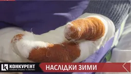 “Пийнув і пішов через ліс вісім кілометрів”: волинянин ледь не втратив руки через обмороження (відео)