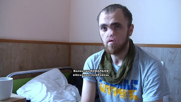 Понівечені війною: як у волинській лікарні допомагають повертати обличчя пораненим воїнам