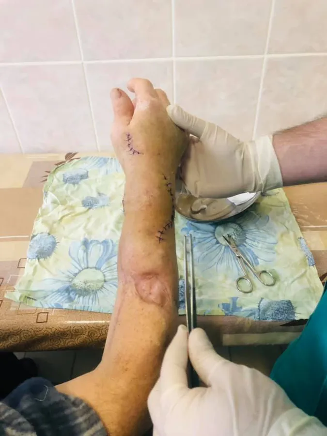 Відрізав циркуляркою: як в луцькій лікарні рятували чоловікові руку