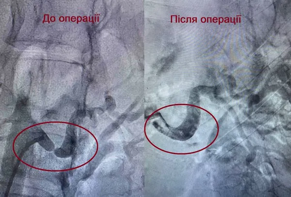 Успішна операція: у Ковелі лікарі зберегли нирку пацієнтці