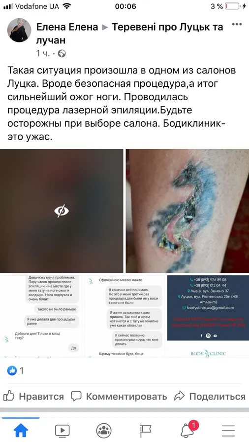 Лазерна епіляція у луцькому салоні завершилася опіком: що кажуть лікарі (відео)