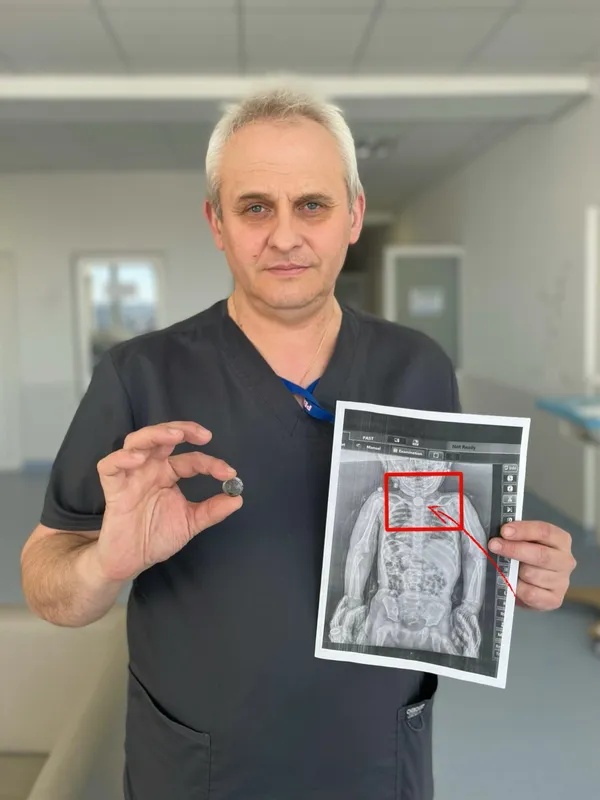 Хірурги діяли максимально обережно: батарейка була щільно зафіксована, а будь-яка маніпуляція могла призвести до перфорації стравоходу, тобто його розриву