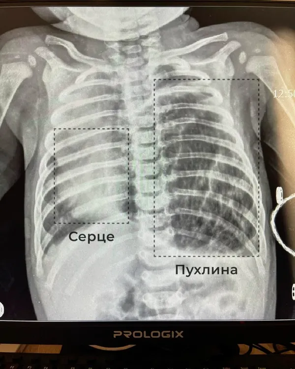 За лічені години до смерті: у Львові медики врятували немовля із величезною пухлиною у грудях (фото)