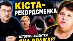 «Носила на собі відро води»: у Луцьку жінці видалили гігантську кісту (відео)