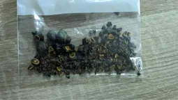Волинські хірурги вийняли понад 100 каменів з одного пацієнта (фото)