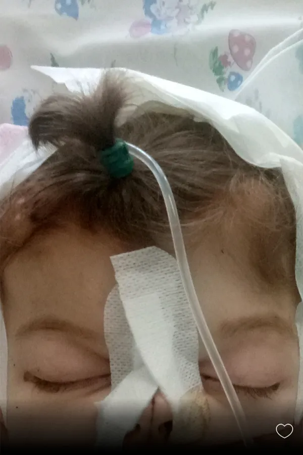 Важка операція на черепі: маленькій лучанці терміново потрібна допомога (фото)