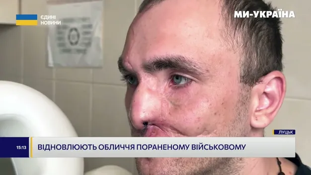 «Не було ні носа, ні щелепи»: у Луцьку канадські лікарі повернули обличчя пораненому бійцю (відео)