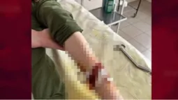У Нововолинську безпритульний собака покусав 9-річного хлопчика: що каже мер (відео)