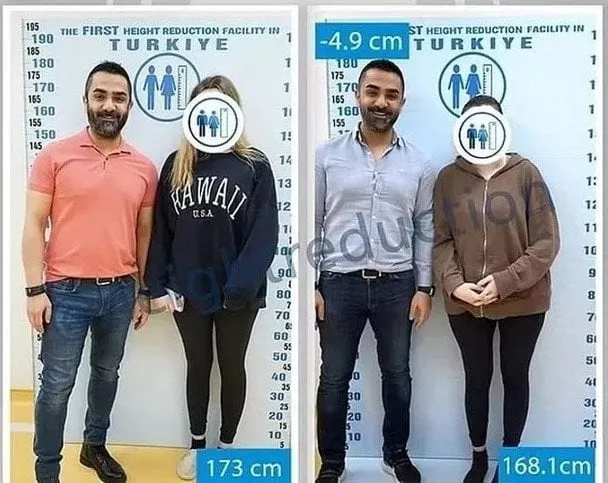 Небезпечні тренди: жінки вкорочують собі ноги, щоб знайти кохання