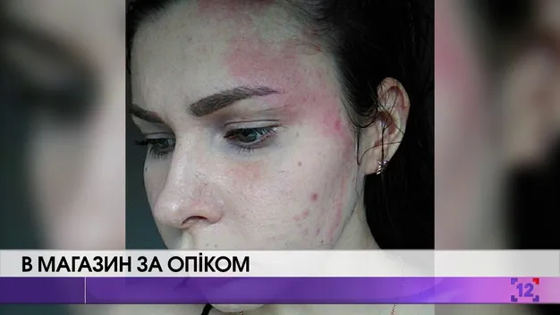 У Луцьку дівчина отримала в магазині хімічні опіки (відео)