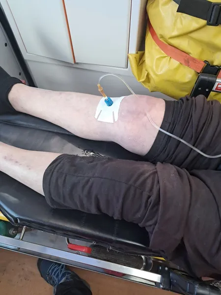 На Волині змогли стабілізувати чоловіка, у якого було тільки 24 удари серця за хвилину