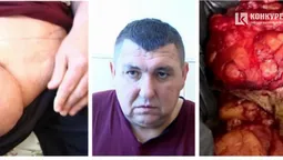 Після операції волинянин полегшав на 25 кг: як так сталося (фото, відео 18+)