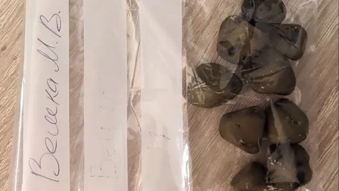 У Володимирі хірурги видалили з жовчного міхура пацієнта дев’ять чималих каменів (фото