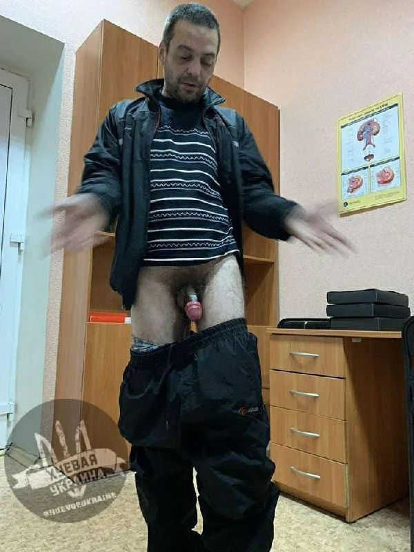 У Запоріжжі ревнива дружина накрутила чоловіку гайку на статевий член (фото 18+)