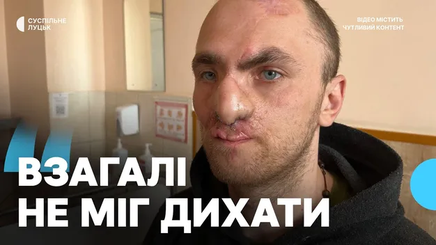 «Зараз можу пройтися без маски»: бійцю з Волині зробили 5 операцій з відновлення обличчя (фото, відео)